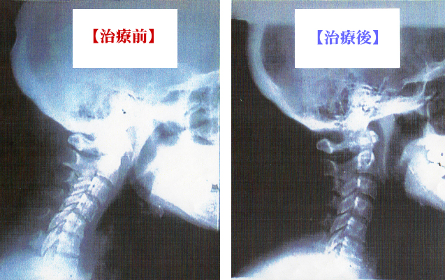 首：上部頸椎の例