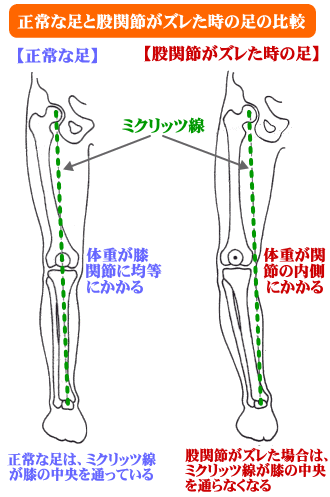 正常な足と股関節がズレた時の足の比較